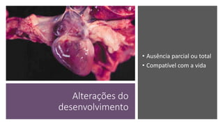 Alterações do
desenvolvimento
• Ausência parcial ou total
• Compatível com a vida
 
