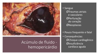 Acúmulo de fluido -
hemopericárdio
• Sangue
ØTraumas atriais
e vasculares
ØPerfuração
do coração
ØNeoplasias
• Pouco frequente e fatal
• Consequências:
ØChoque cardiogênico
ØInsuficiência
cardíaca aguda
 