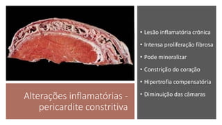 Alterações inflamatórias -
pericardite constritiva
• Lesão inflamatória crônica
• Intensa proliferação fibrosa
• Pode mineralizar
• Constrição do coração
• Hipertrofia compensatória
• Diminuição das câmaras
 