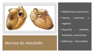 Necrose do miocárdio
• Deficiências nutricionais
• Toxinas - químicas e
vegetais
• Isquemia - embolia,
trombose, aneurismas
• Infeciosas - miocardites
 