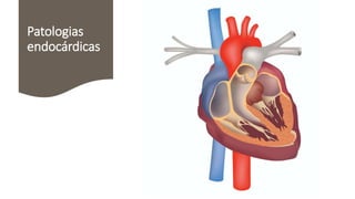 Patologias
endocárdicas
 