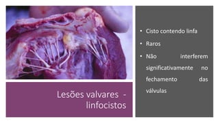 Lesões valvares -
linfocistos
• Cisto contendo linfa
• Raros
• Não interferem
significativamente no
fechamento das
válvulas
 