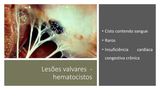 Lesões valvares -
hematocistos
• Cisto contendo sangue
• Raros
• Insuficiência cardíaca
congestiva crônica
 