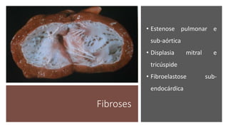 Fibroses
• Estenose pulmonar e
sub-aórtica
• Displasia mitral e
tricúspide
• Fibroelastose sub-
endocárdica
 