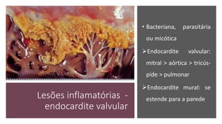 Lesões inflamatórias -
endocardite valvular
• Bacteriana, parasitária
ou micótica
Endocardite valvular:
mitral > aórtica > tricús-
pide > pulmonar
Endocardite mural: se
estende para a parede
 