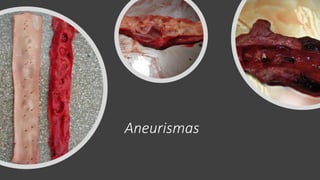 Aneurismas
 