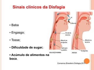 Sinais clínicos da Disfagia
Consenso Brasileiro Disfagia,2011
▪ Baba
▪ Engasgo;
▪ Tosse;
▪ Dificuldade de sugar;
▪ Acúmulo de alimentos na
boca.
 