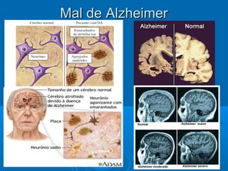 MMaall ddee AAllzzhheeiimmeerr 
 