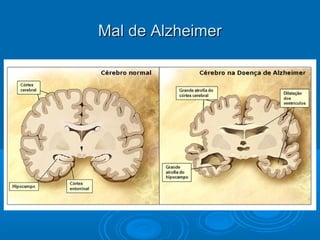 MMaall ddee AAllzzhheeiimmeerr 
 