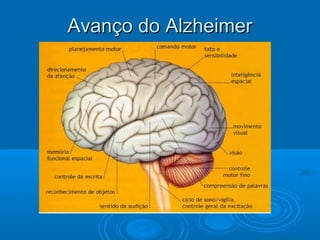 AAvvaannççoo ddoo AAllzzhheeiimmeerr 
 