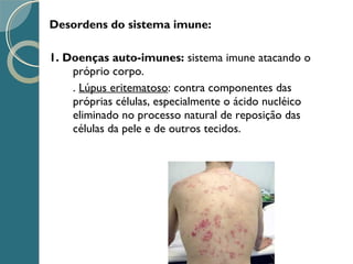 Desordens do sistema imune:
1. Doenças auto-imunes: sistema imune atacando o
próprio corpo.
. Lúpus eritematoso: contra componentes das
próprias células, especialmente o ácido nucléico
eliminado no processo natural de reposição das
células da pele e de outros tecidos.
 