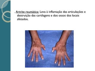 . Artrite reumática: Leva à inflamação das articulações e
destruição das cartilagens e dos ossos dos locais
afetados.
 