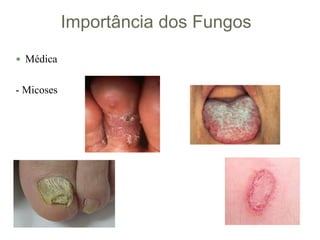 Importância dos Fungos
 Médica
- Micoses
 
