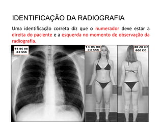 IDENTIFICAÇÃO DA RADIOGRAFIA
Uma identificação correta diz que o numerador deve estar a
direita do paciente e a esquerda no momento de observação da
radiografia.
 