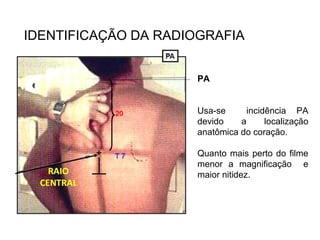 IDENTIFICAÇÃO DA RADIOGRAFIA
PA
Usa-se incidência PA
devido a localização
anatômica do coração.
Quanto mais perto do filme
menor a magnificação e
maior nitidez.
 