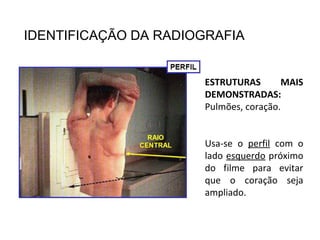 IDENTIFICAÇÃO DA RADIOGRAFIA
ESTRUTURAS MAIS
DEMONSTRADAS:
Pulmões, coração.
Usa-se o perfil com o
lado esquerdo próximo
do filme para evitar
que o coração seja
ampliado.
 