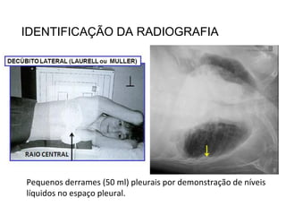 IDENTIFICAÇÃO DA RADIOGRAFIA
Pequenos derrames (50 ml) pleurais por demonstração de níveis
líquidos no espaço pleural.
 
