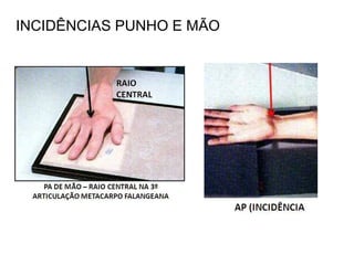 INCIDÊNCIAS PUNHO E MÃO
 