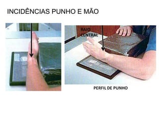 INCIDÊNCIAS PUNHO E MÃO
 