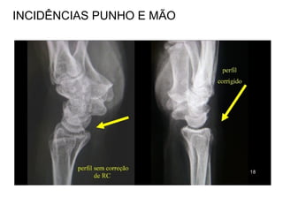 INCIDÊNCIAS PUNHO E MÃO
 