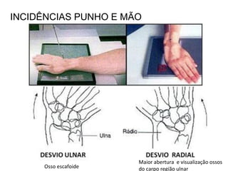 INCIDÊNCIAS PUNHO E MÃO
Osso escafoide
Maior abertura e visualização ossos
do carpo região ulnar
 