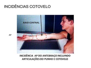 INCIDÊNCIAS COTOVELO
AP
 