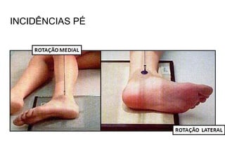 INCIDÊNCIAS PÉ
 