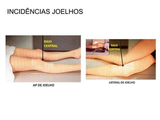 INCIDÊNCIAS JOELHOS
 