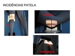 PA
INCIDÊNCIAS PATELA
LATERAL
TANGENCIAL
 