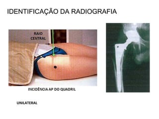 IDENTIFICAÇÃO DA RADIOGRAFIA
UNILATERAL
 
