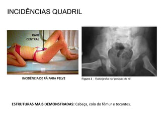 ESTRUTURAS MAIS DEMONSTRADAS: Cabeça, colo do fêmur e tocantes.
INCIDÊNCIAS QUADRIL
 