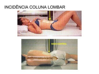 INCIDÊNCIA COLUNA LOMBAR
 