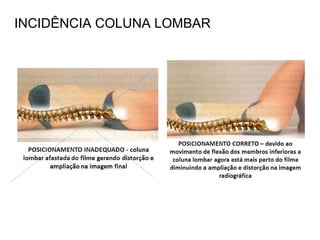 INCIDÊNCIA COLUNA LOMBAR
 