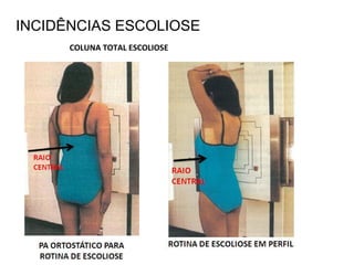 INCIDÊNCIAS ESCOLIOSE
COLUNA TOTAL ESCOLIOSE
 