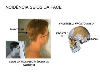 INCIDÊNCIA SEIOS DA FACE
 