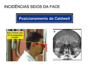 INCIDÊNCIAS SEIOS DA FACE
 
