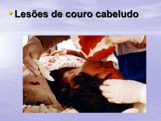 • Lesões de couro cabeludo
 