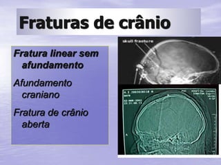 Fraturas de crânio
Fratura linear sem
afundamento
Afundamento
craniano
Fratura de crânio
aberta
 