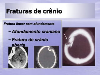Fratura linear sem afundamento
– Afundamento craniano
– Fratura de crânio
aberta
Fraturas de crânio
 