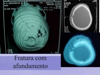 Fratura com
afundamento
 