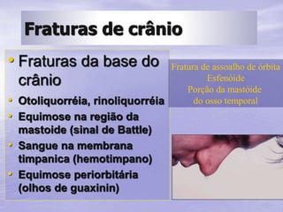 • Fraturas da base do
crânio
• Otoliquorréia, rinoliquorréia
• Equimose na região da
mastoide (sinal de Battle)
• Sangue na membrana
timpanica (hemotimpano)
• Equimose periorbitária
(olhos de guaxinin)
Fratura de assoalho de órbita
Esfenóide
Porção da mastóide
do osso temporal
Fraturas de crânio
 