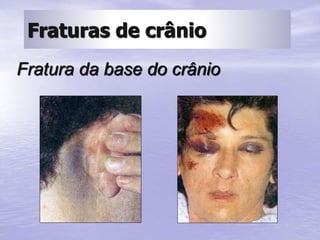 Fratura da base do crânio
Fraturas de crânio
 
