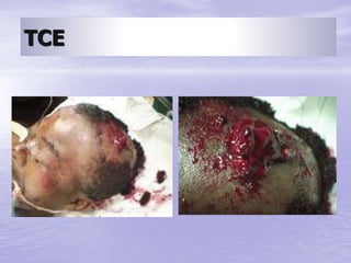 TCE
 