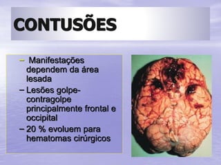 CONTUSÕES
– Manifestações
dependem da área
lesada
– Lesões golpe-
contragolpe
principalmente frontal e
occipital
– 20 % evoluem para
hematomas cirúrgicos
 