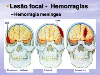 • Lesão focal - Hemorragias
– Hemorragia meningea
Hematomas: Subdural Epidural Intracerebral
 