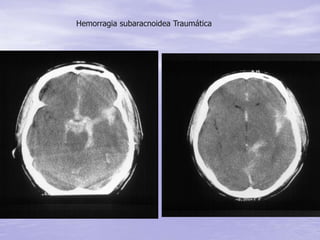 Hemorragia subaracnoidea Traumática
 