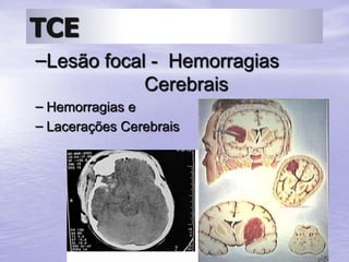 Prof. Fernando Ramos Gonçalves
TCE
–Lesão focal - Hemorragias
Cerebrais
– Hemorragias e
– Lacerações Cerebrais
 