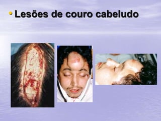 • Lesões de couro cabeludo
 