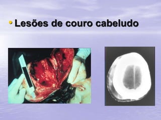 • Lesões de couro cabeludo
 