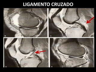LIGAMENTO CRUZADO
 